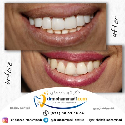 ونیر طرح لبخند